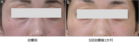 肝斑・色調改善