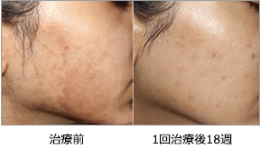 炎症後色素沈着